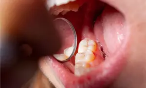 Widok jamy ustnej z widocznymi zębami i lustrem dentystycznym. Na jednym z zębów widoczne są oznaki demineralizacji szkliwa.