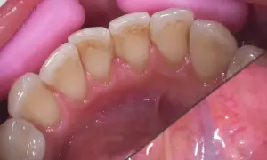 Widok jamy ustnej z widocznymi przebarwieniami na zębach, przypominającymi czarną aftę w jamie ustnej. Różowe separatory dentystyczne.