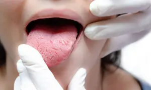 Język z widocznymi zmianami, być może związanymi z grzybicą jamy ustnej. Czy kefir może pomóc?