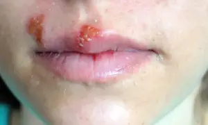 Ból zęba może być powiązany z opryszczką na ustach, która jest widoczna na zdjęciu.