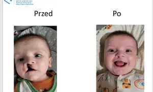 Uśmiechnięty chłopiec po operacji rozciętej wargi. Wcześniej widoczne było rozcięcie, teraz jego uśmiech jest pełny.