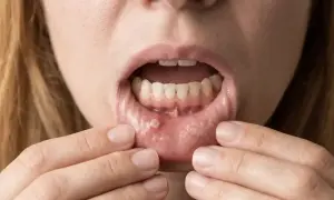 Otwarta rana w jamie ustnej, widoczna na dolnej wardze, z białym nalotem i zaczerwienieniem.