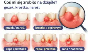 Krwiak na dziąśle może wyglądać jak guzek, krostka lub narośl. Ilustracja pokazuje różne stadia problemu, od małych zmian po ropę i ranę.