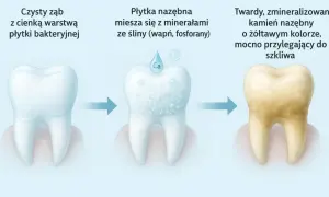Proces powstawania kamienia nazębnego z płytki bakteryjnej i minerałów ze śliny, prowadzący do próchnicy.