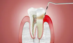 Przekrój zęba z widocznym zapaleniem dziąseł i narzędziem dentystycznym.