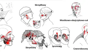 Ilustracje pokazują punkty bólu związane z różnymi mięśniami głowy i szyi, pomocne w zrozumieniu domowych sposobów na ból stawu skroniowo-żuchwowego.