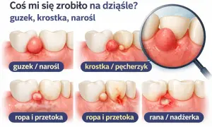 Ilustracja pokazuje różne zmiany na dziąśle: guzek, krostkę, ropę i przetokę, a także ranę. Widoczna jest dziura w zębie przy dziąśle.
