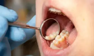 Usta otwarte, dentysta w rękawiczce bada zęby lusterkiem. Widać zdrowe, białe zęby, bez próchnicy.