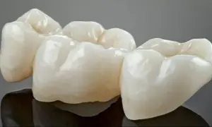 Trzy ceramiczne korony, gotowe do rekonstrukcji zęba, lśnią na ciemnym tle.