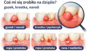 Ilustracje pokazują różne zmiany na dziąsłach: guzek, krostkę, ropę i przetokę, ranę. Mogą to być objawy podrażnień dziąseł.