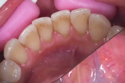 Widok jamy ustnej z widocznymi przebarwieniami na zębach, przypominającymi czarną aftę w jamie ustnej. Różowe separatory dentystyczne.