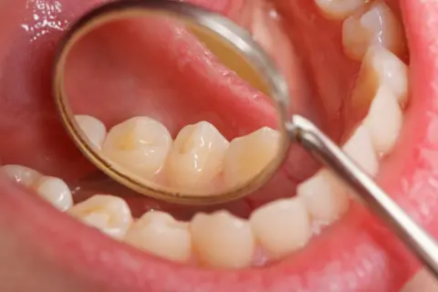 Widok jamy ustnej z lusterkiem dentystycznym. Widoczne zęby z przebarwieniami, które mogą świadczyć o tym, jak szybko rozwija się próchnica.