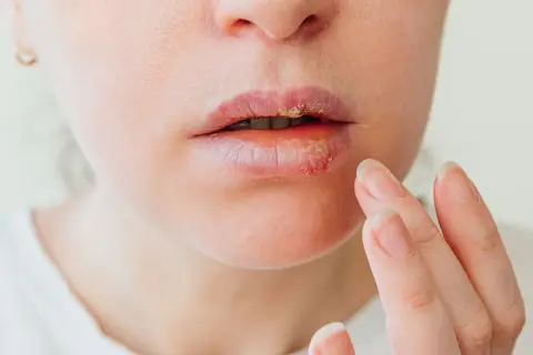 Czerwone plamy na ustach, które wyglądają na opryszczkę, są widoczne na zbliżeniu. Kobieta dotyka palcami ust.