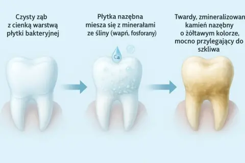 Proces powstawania kamienia nazębnego u dziecka: od czystego zęba, przez płytkę nazębną mieszającą się z minerałami, aż do żółtawego, twardego kamienia.