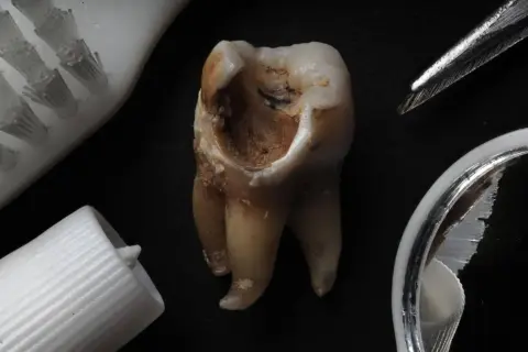 Zniszczony ząb z widocznymi czarnymi kreskami na powierzchni, obok szczoteczki, pasty i pęsety.
