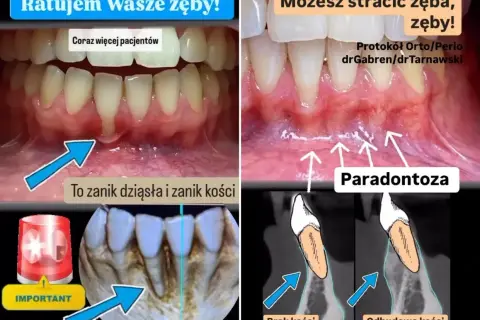 Widok jamy ustnej z widocznym zanikiem dziąseł i kości, odsłaniającym korzeń zęba. Obok schemat porównujący brak kości z jej odbudową.