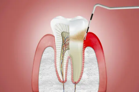 Przekrój zęba z widocznym zapaleniem dziąseł i narzędziem dentystycznym.