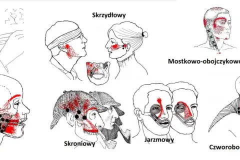 Ilustracje pokazują punkty bólu związane z różnymi mięśniami głowy i szyi, pomocne w zrozumieniu domowych sposobów na ból stawu skroniowo-żuchwowego.