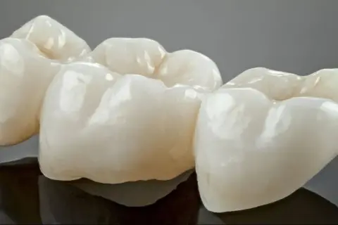 Trzy ceramiczne korony, gotowe do rekonstrukcji zęba, lśnią na ciemnym tle.