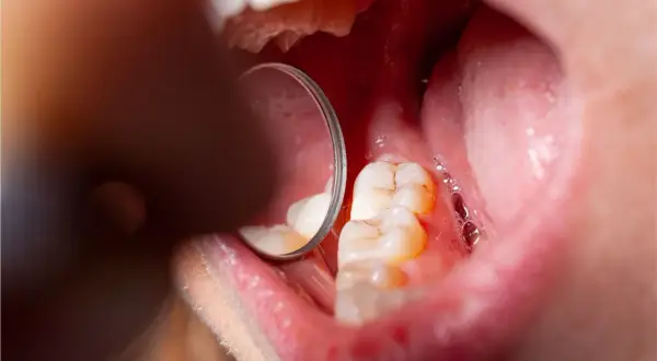 Widok jamy ustnej z widocznymi zębami i lustrem dentystycznym. Na jednym z zębów widoczne są oznaki demineralizacji szkliwa.