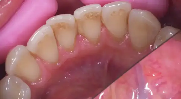 Widok jamy ustnej z widocznymi przebarwieniami na zębach, przypominającymi czarną aftę w jamie ustnej. Różowe separatory dentystyczne.