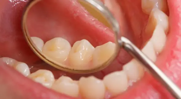 Widok jamy ustnej z lusterkiem dentystycznym. Widoczne zęby z przebarwieniami, które mogą świadczyć o tym, jak szybko rozwija się próchnica.