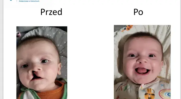 Uśmiechnięty chłopiec po operacji rozciętej wargi. Wcześniej widoczne było rozcięcie, teraz jego uśmiech jest pełny.
