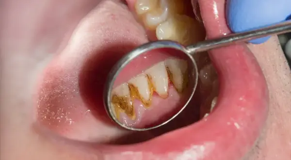 Widok zęba w lusterku dentystycznym, gdzie kamień nazębny sam odpada, odsłaniając zdrowszą powierzchnię.