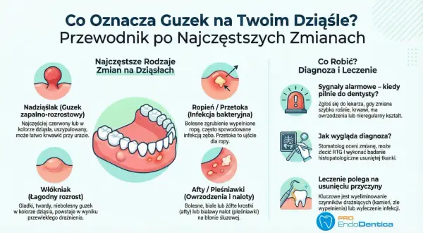 Ilustracja przedstawia ropień, czyli przetokę na dziąśle, która jest bolesnym zgrubieniem wypełnionym ropą, często spowodowanym infekcją zęba.