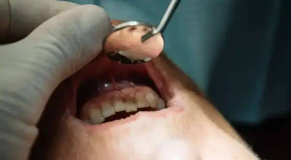 Badne objawy ropnia mózgu od zęba mogą być subtelne. Dentysta bada jamę ustną, szukając przyczyn problemów.
