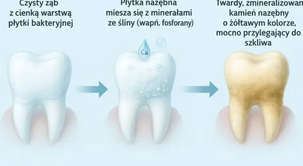 Proces powstawania kamienia nazębnego u dziecka: od czystego zęba, przez płytkę nazębną mieszającą się z minerałami, aż do żółtawego, twardego kamienia.