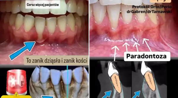 Widok jamy ustnej z widocznym zanikiem dziąseł i kości, odsłaniającym korzeń zęba. Obok schemat porównujący brak kości z jej odbudową.
