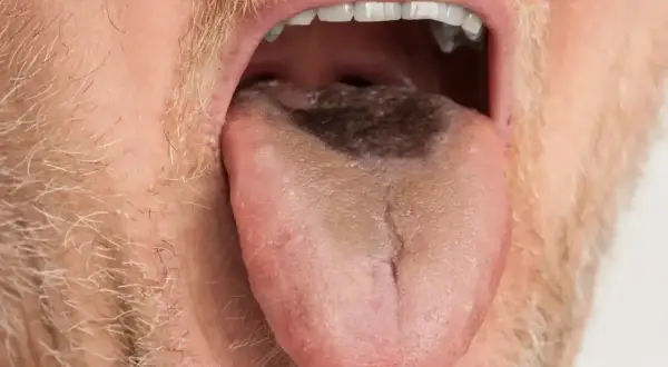 Czarny nalot na języku? Dowiedz się, jak wyczyścić język z nalotu i odzyskać świeży oddech.