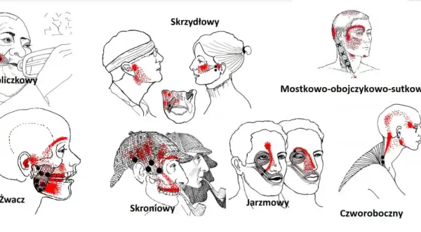 Ilustracje pokazują punkty bólu związane z różnymi mięśniami głowy i szyi, pomocne w zrozumieniu domowych sposobów na ból stawu skroniowo-żuchwowego.