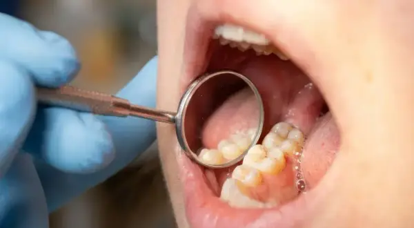 Usta otwarte, dentysta w rękawiczce bada zęby lusterkiem. Widać zdrowe, białe zęby, bez próchnicy.