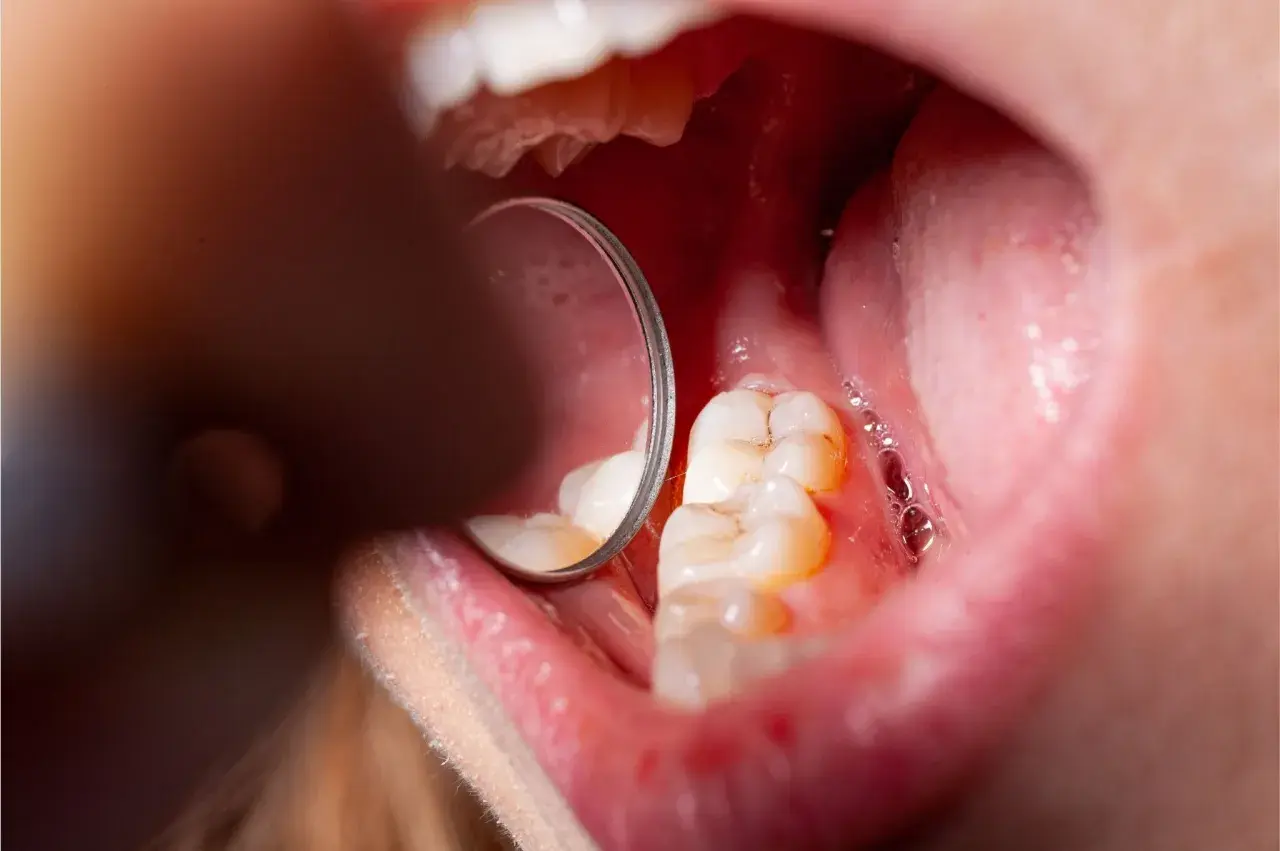 Widok jamy ustnej z widocznymi zębami i lustrem dentystycznym. Na jednym z zębów widoczne są oznaki demineralizacji szkliwa.