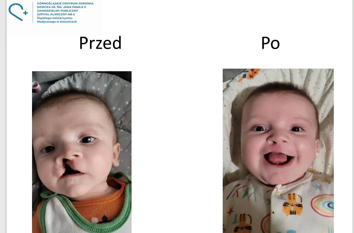 Uśmiechnięty chłopiec po operacji rozciętej wargi. Wcześniej widoczne było rozcięcie, teraz jego uśmiech jest pełny.