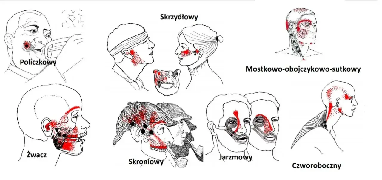 Ilustracje pokazują punkty bólu związane z różnymi mięśniami głowy i szyi, pomocne w zrozumieniu domowych sposobów na ból stawu skroniowo-żuchwowego.