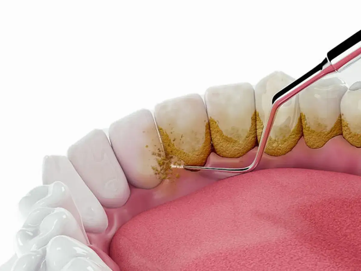Usuwanie kamienia nazębnego. Instrument dentystyczny usuwa żółty kamień z zębów, odsłaniając zdrowe dziąsła.