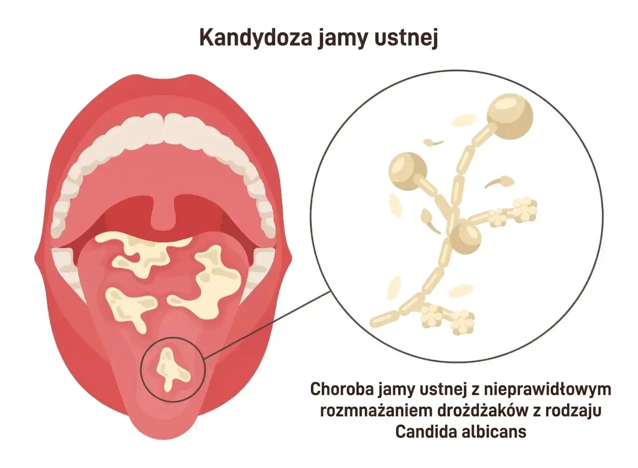 Kandydoza jamy ustnej: białe naloty na języku i podniebieniu, powiększone drożdżaki Candida albicans.