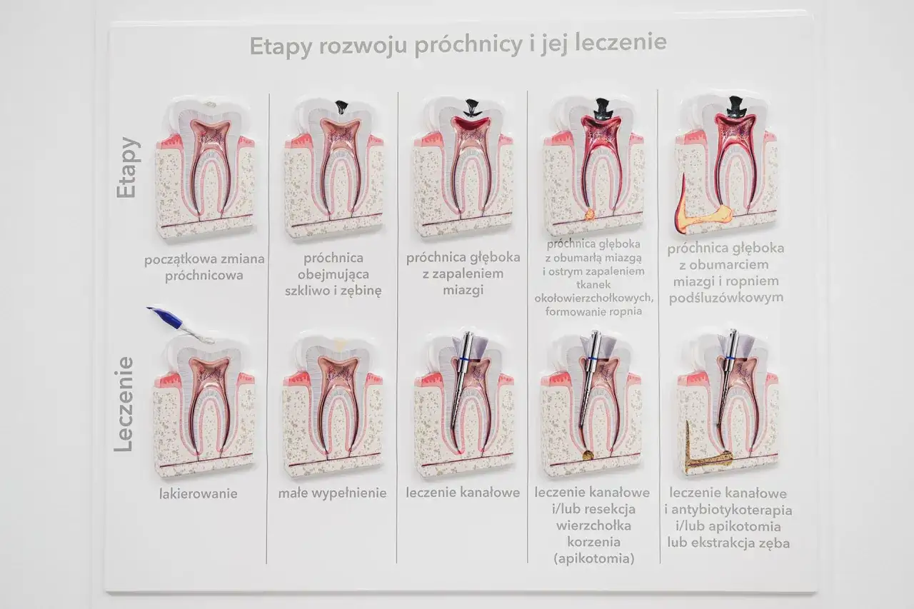 Model przedstawia etapy rozwoju próchnicy i jej leczenie, od początkowej zmiany do zaawansowanej próchnicy z ropniem, pokazując metody leczenia.