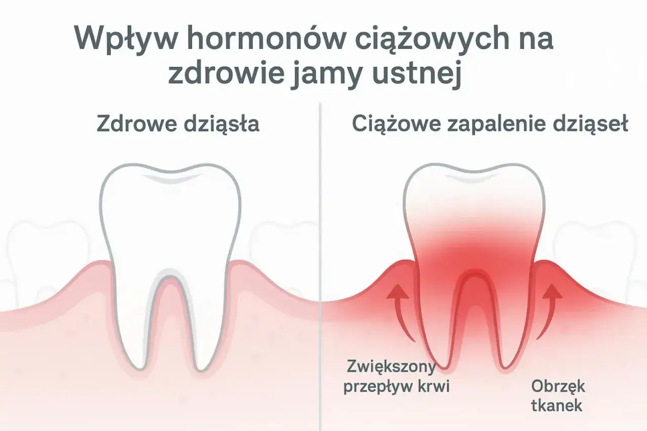 Porównanie zdrowych dziąseł z objawami zapalenia dziąseł w ciąży: obrzęk i zwiększony przepływ krwi, co może prowadzić do krwawiących dziąseł w ciąży.