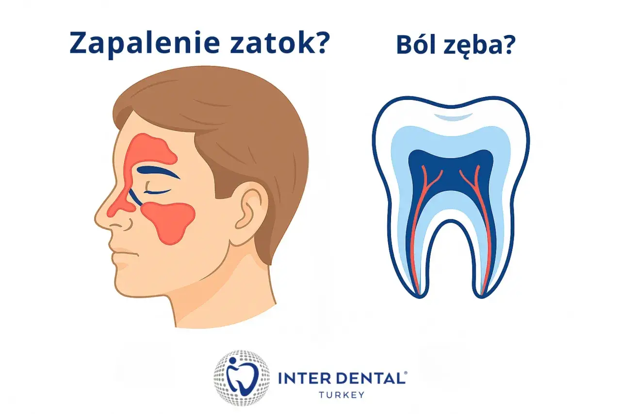 Zapalenie zatok czy b&oacute;l wszystkich zęb&oacute;w? Ilustracja por&oacute;wnuje objawy zapalenia zatok z budową zęba, sugerując, że b&oacute;l zęba może być mylony z innymi dolegliwościami.
