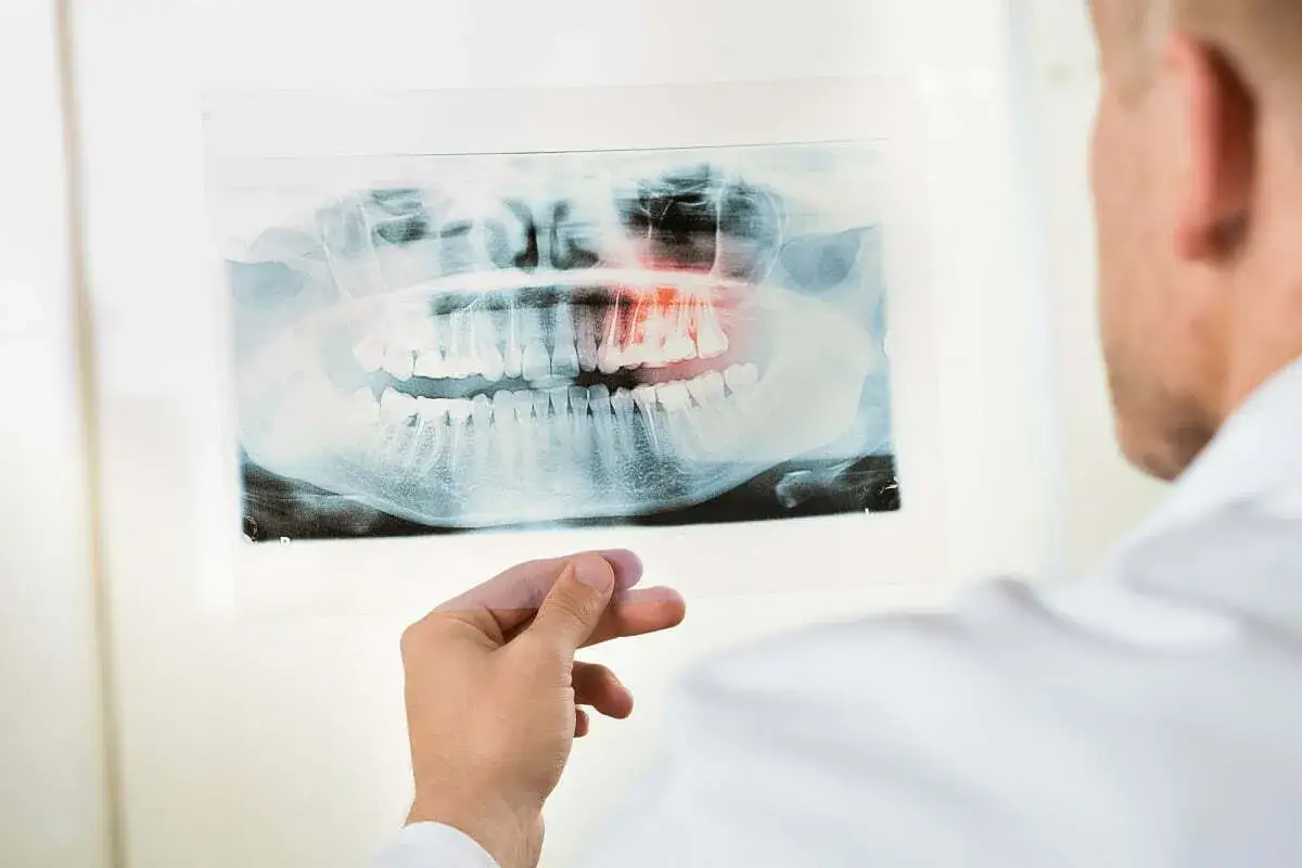 Dentysta analizuje zdjęcie RTG szczęki, gdzie widoczna jest czerwona plama wskazująca na torbiel w szczęce.