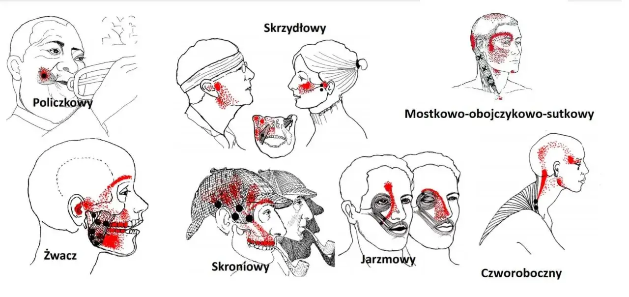 Ilustracje pokazują punkty bólu związane ze skurczem szczęki w różnych obszarach głowy i szyi, od policzka po kark.