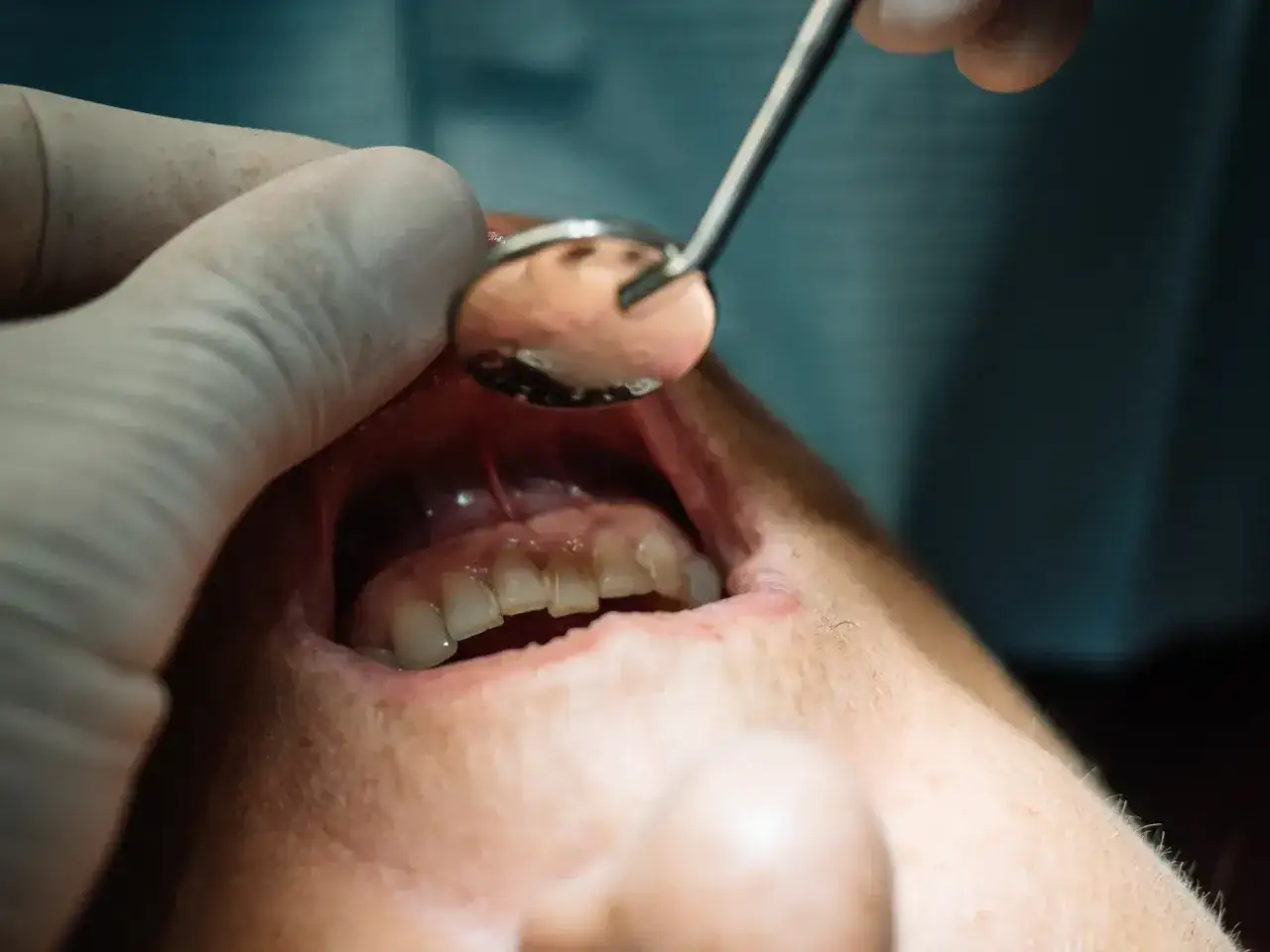 Dentysta bada zęby, szukając przyczyny opuchlizny. Może potrzebny antybiotyk na opuchliznę zęba bez recepty?