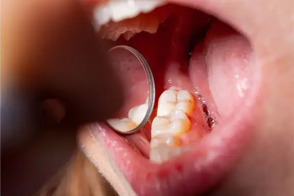 Widok jamy ustnej z widocznymi zębami i lustrem dentystycznym. Na jednym z zębów widoczne są oznaki demineralizacji szkliwa.