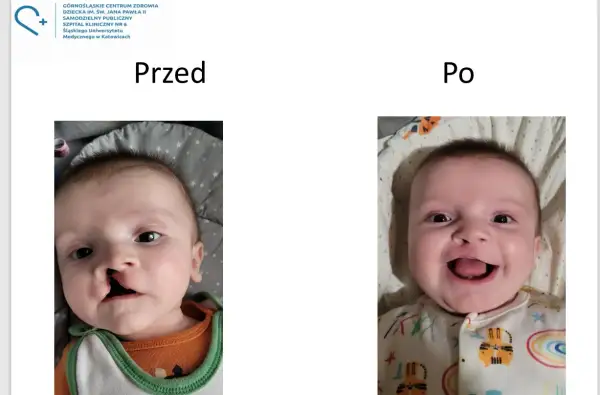 Uśmiechnięty chłopiec po operacji rozciętej wargi. Wcześniej widoczne było rozcięcie, teraz jego uśmiech jest pełny.