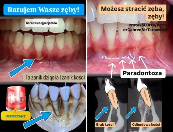 Widok jamy ustnej z widocznym zanikiem dziąseł i kości, odsłaniającym korzeń zęba. Obok schemat porównujący brak kości z jej odbudową.