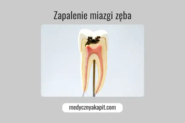 Model zęba ukazujący próchnicę sięgającą miazgi, co prowadzi do zapalenia miazgi.